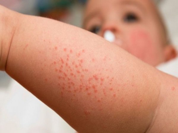 Bệnh Xuất huyết giảm tiểu cầu có nguy hiểm?