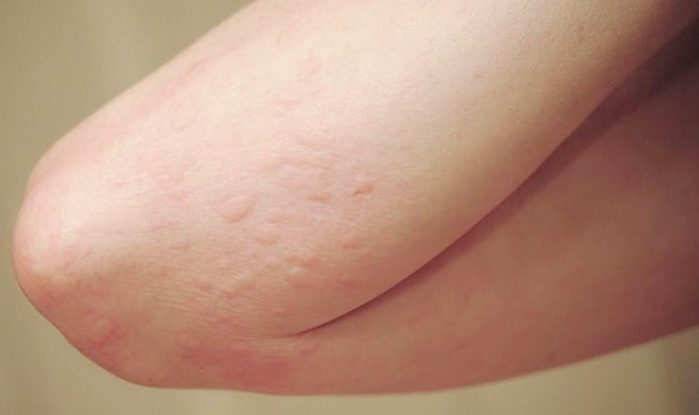 Mề đay cấp và những điều bạn cần biết