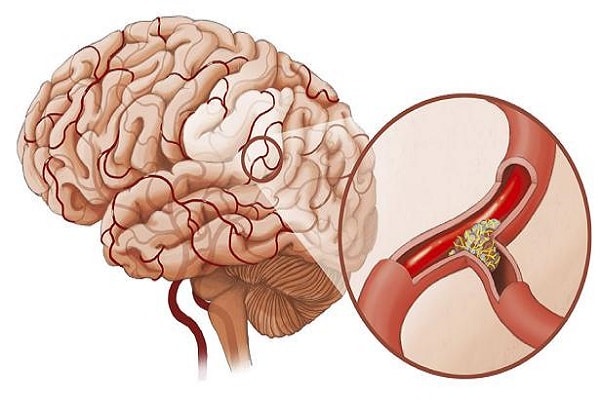 Thiếu máu não mạch máu nhỏ là gì?