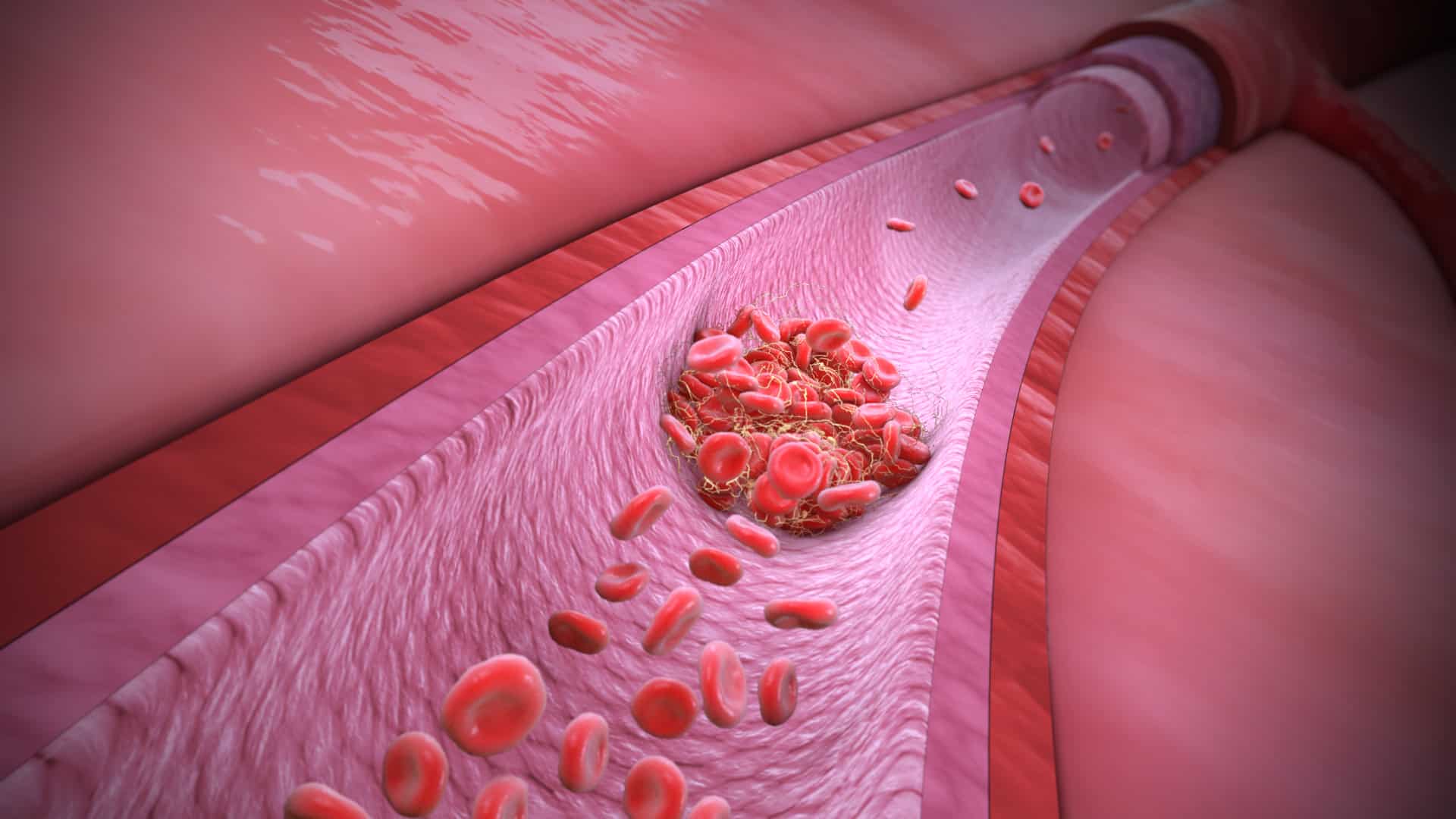 Thrombophilia – Tình trạng tăng khả năng đông máu