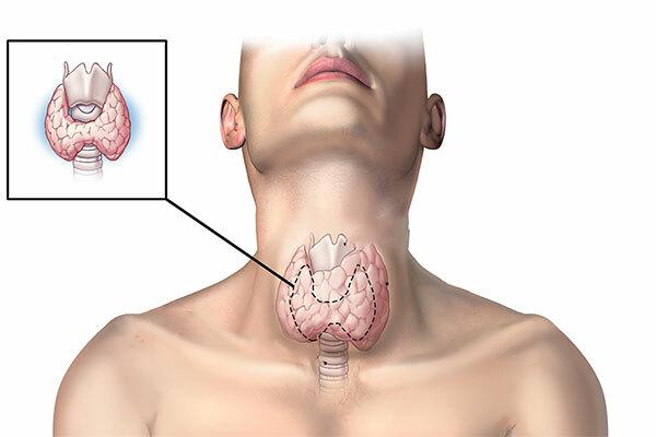 U tuyến giáp: Triệu chứng và Biểu hiện nhằm điều trị sớm